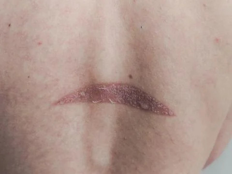 Sunburn on woman's red blistered back Stock Photos