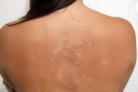 Sunburned, peeling female (3) Stock Photos