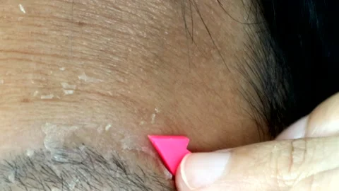 Sunburned peeling skin Video stock 328898972