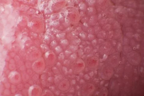 Super macro surface of tongue candidiasis overgrowth Stock Photos
