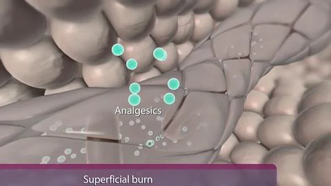 Superfucial Partial, Thickness Burn Stock Illustration