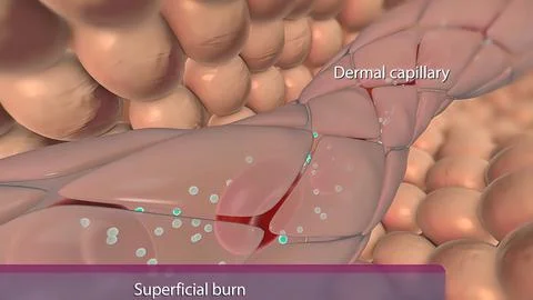 Superfucial Partial, Thickness Burn Stock Illustration