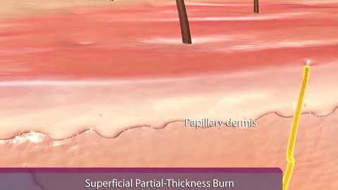 Superfucial Partial, Thickness Burn Stock Illustration