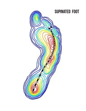 Supinated foot, arch deformation, bottom view. Foot weight distribution. Stock Illustration