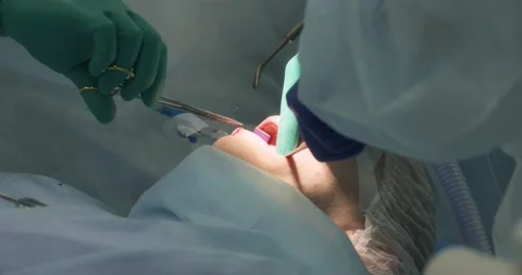 The surgeon applies a suture after removing wisdom teeth to the patient Stock Footage 166203228