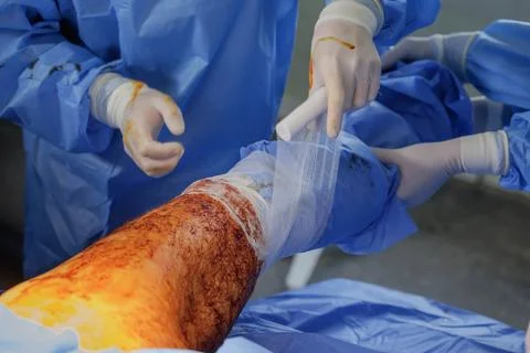 Surgeon Applying Dressing to Wounded Leg in Medical Setting Stock Photos