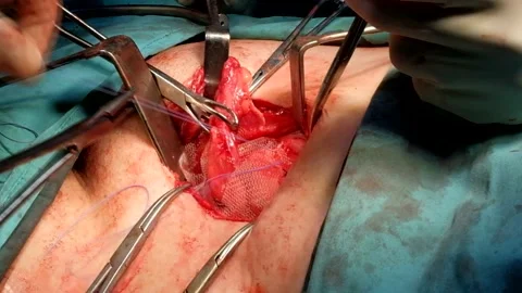 Surgeon applying mesh during hernia surgery Stock Footage 131788964