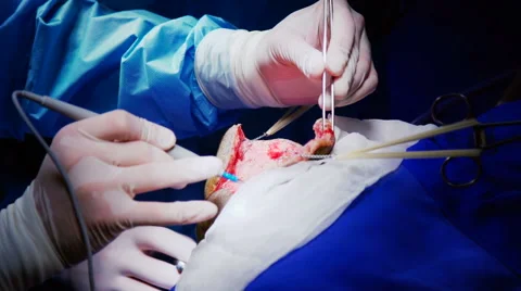The Surgeon Conducting the Operation of Craniotomy Stock Footage 64796305
