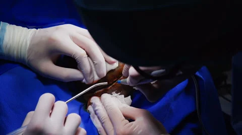The Surgeon Conducting the Operation of Craniotomy Stock Footage 64798517