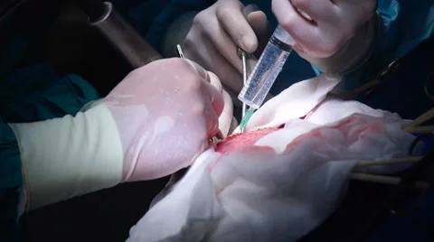 The Surgeon Conducting the Operation of Craniotomy Stock Footage 64798658