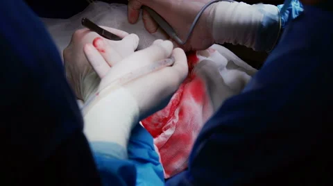 The Surgeon Conducting the Operation of Craniotomy Stock Footage 64799010