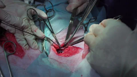The surgeon cuts the artery scissors Stock-Footage 91610409