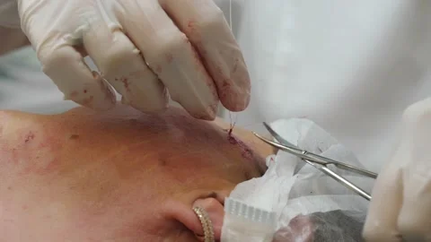 The surgeon cuts the threads after plastic surgery on the patient's face. Stock Footage 165821814