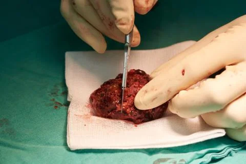 Surgeon cutting specimen in the brain causing seizure. Stock Photos