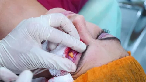 Surgeon do plastic surgery. Eye surgery. A surgeon removing piece of skin from Stock Footage 145601962