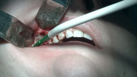 Surgeon do removal of caries on teeth a patient in modern office clinic Stockbeeldmateriaal 118295435