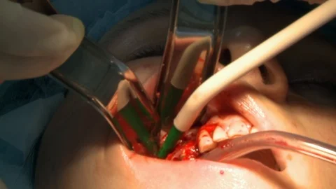 Surgeon do uses drilling gums a patient in modern office clinic operating room Stockbeeldmateriaal 118801325