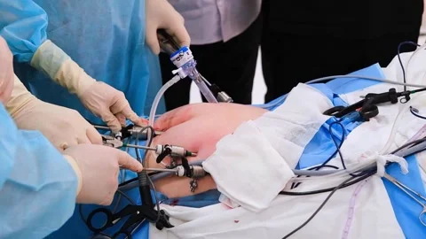 The surgeon does endoscopic surgery on the abdomen. The doctor performs Stock Footage 251713654