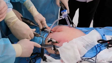 The surgeon does endoscopic surgery on the abdomen. The doctor performs Stock Footage 259757859