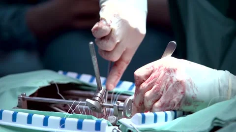 Surgeon doing heart surgery Stock Footage 44247405