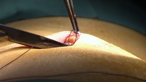Surgeon doing sutures Stock Footage 85941548