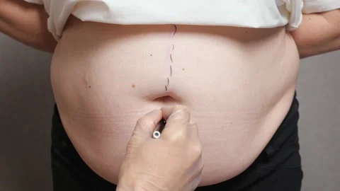 Surgeon draws correction marks on belly for plastic surgery Stock Footage 194946378