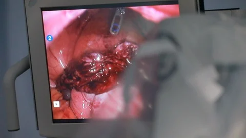 Surgeon explains on the robotic console display in operations room using robo 動画素材 102187072