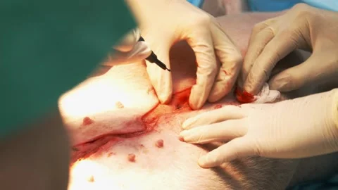 Surgeon Hands Close Up Operating with laser scalpel. close up of mock surgery Stock Footage 199522874