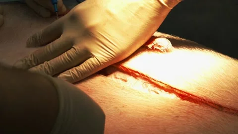 Surgeon Hands Close Up Operating with scalpel. close up of mock surgery with Stock Footage 199523151