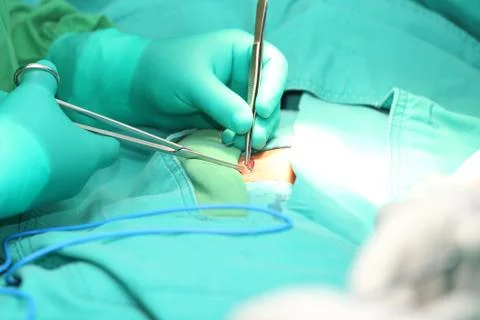 Surgeon hands suturing an hernia Stock Photos