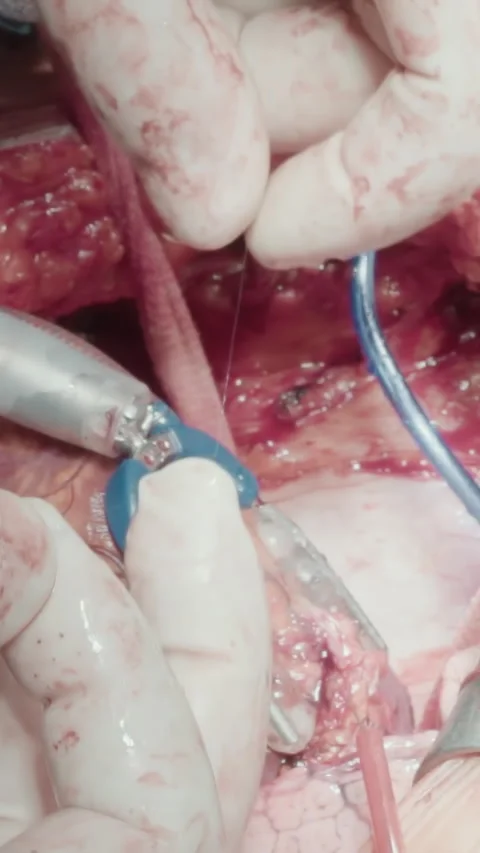 Surgeon holds thread operating heart Stock Footage 316504275