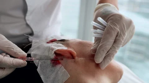 The surgeon inserts a needle with threads to tighten the skin. Rejuvenation Video stock 232400027