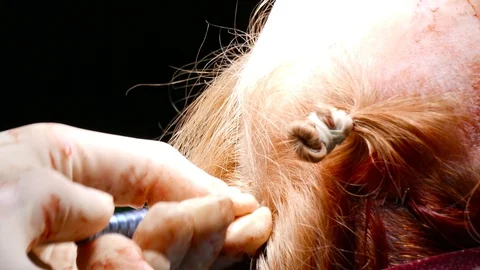 The surgeon inserts a screw into the patient’s skull Stock Footage 123572287