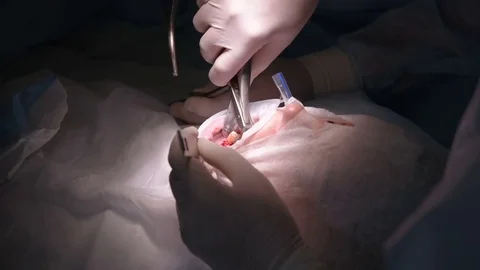 The surgeon makes a dental operation Stock Footage 79620220