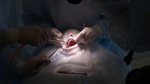 The surgeon makes a dental operation Stock-Footage 79620255