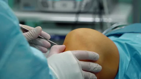 The surgeon makes an incision in the knee joint to place the camera 스톡 동영상 164329396