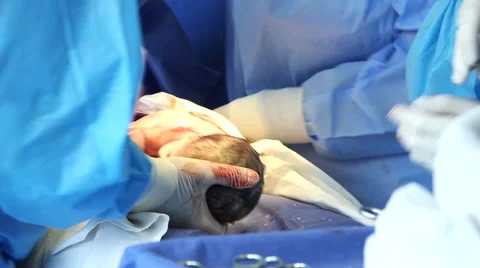 Surgeon making Cesarean section Video stock 54968682
