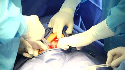 Surgeon making Cesarean section Video stock 54968823