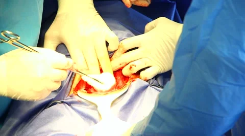 Surgeon making Cesarean section Video stock 54969336