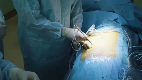 The surgeon making an incision on the abdomen Stock Footage 88635520
