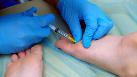 Surgeon making injection anesthesia on boy foot before laser removing of wart. Stock Footage 167822667