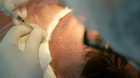 Surgeon making injection of anesthesia in head of bald patient hair transplant. Stock Footage 311878104