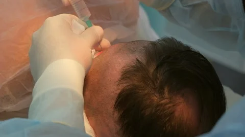 Surgeon making injection anesthesia in head of bald patient to hair transplant. Stock Footage 311878354