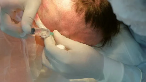 Surgeon making injection anesthesia in head of bald patient to hair transplant. Stock Footage 311878623