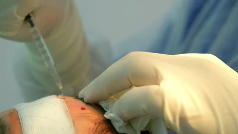 Surgeon making injection of anesthesia in head of bald patient hair transplant. Stock Footage 311881180