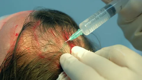 Surgeon making injection of anesthesia in head of bald patient hair transplant. Stock Footage 311881390