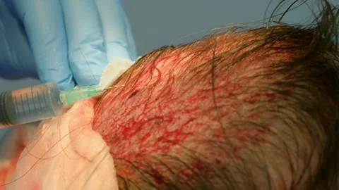Surgeon making injection of anesthesia in head of bald patient hair transplant. Stock Footage 311883086