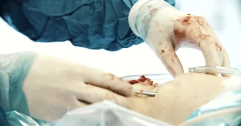 Surgeon manipulating a flexible catheter Stock Footage 49706149