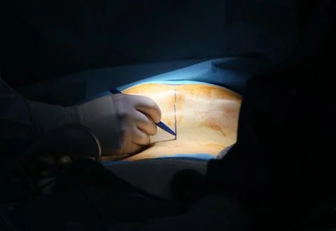 Surgeon is operating Stock Photos