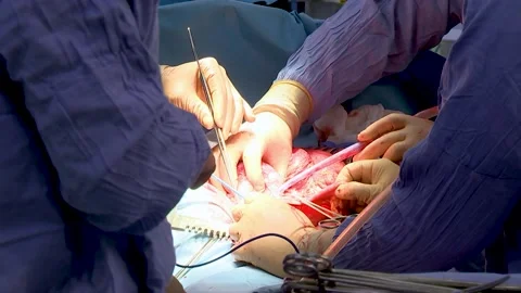 Surgeon operation. Doctor's hands performing operation with surgery tools. Stock Footage 148415741